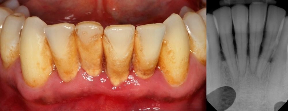 periodontal_treatment4