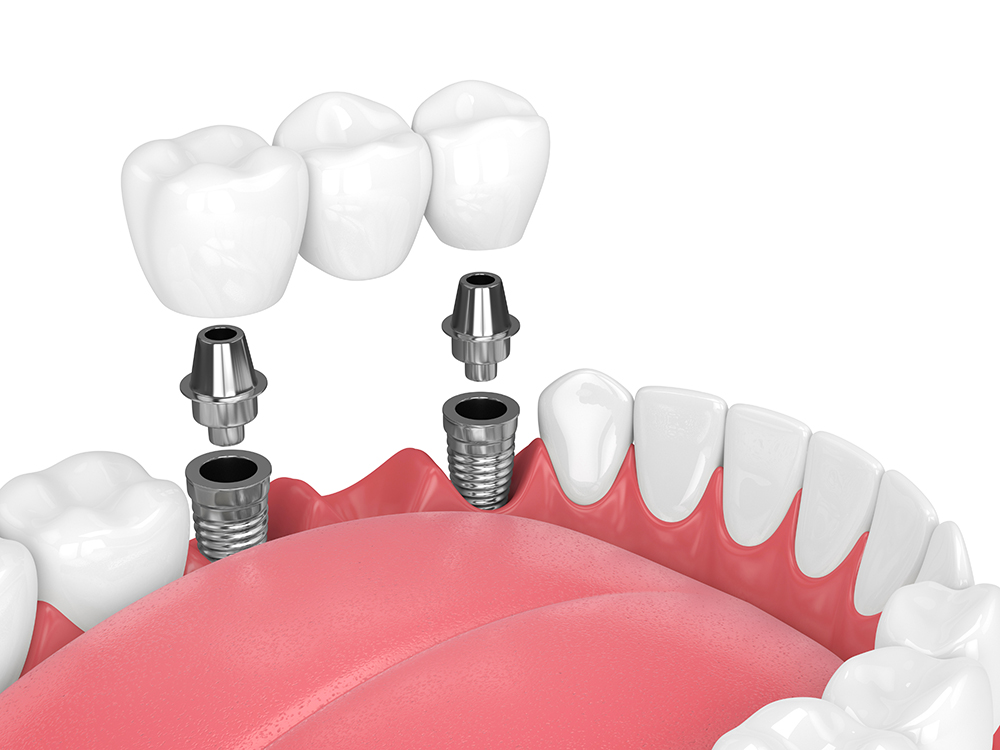 3d render of jaw and implants with dental bridge