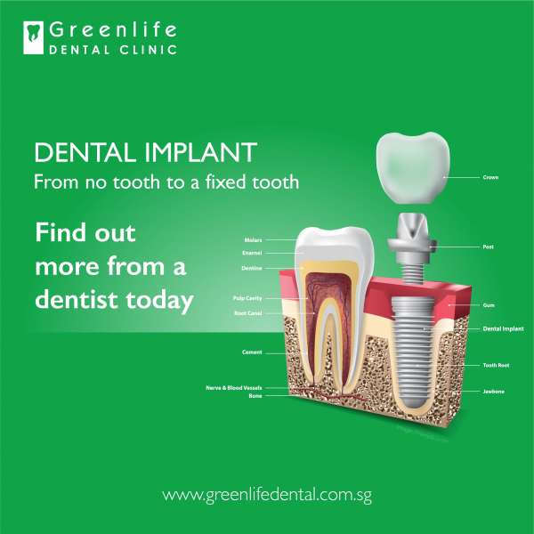 greenlife dental implant feb 2021-01 dental implant